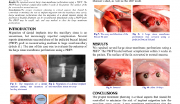 CLOSURE OF LARGE PERFORATIONS OF SINUS MEMBRANE USING A PEDICLED BUCCAL FAT PAD (PBFP) GRAFT