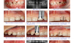 MANAGEMENT OF CONGENITALLY MISSING LATERAL INCISORS WITH ORTHODONTICS AND SINGLE-TOOTH IMPLANTS