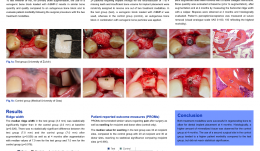 A RANDOMIZED, CONTROLLED CLINICAL TRIAL OF LATERAL RIDGE AUGMENTATION USING AUTOGENOUS BONE BLOCKS OR XENOGENIC BONE BLOCK GRAFTS LOADED WITH RECOMBINANT HUMAN BONE MORPHOGENIC PROTEIN-2)