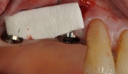 Study Protocols: Soft-Tissue Augmentation 
