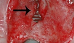 Study Protocols: Ridge Preservation 