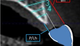 Study Protocols: Horizontal Ridge Augmentation 