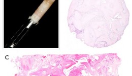 Study Protocols: Maxillary Sinus Floor Elevation 