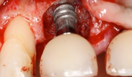 Study Protocols: Treatment Of Peri-Implantitis 