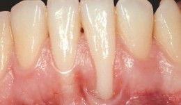 Study Protocols: Root Coverage Regeneration 