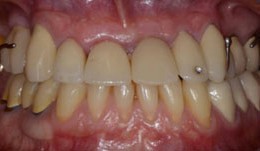 Tendency of skeletal class 3 and a missing front tooth