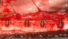 Horizontal Ridge Augmentation