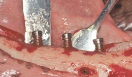 Vertical Ridge Augmentation