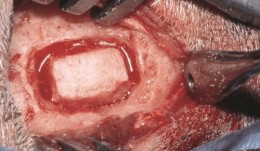 Sinus Floor Augmentation