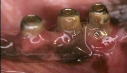 Peri-implantitis Defect