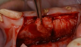 Soft Tissue Regeneration