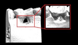 Periodontal Regeneration