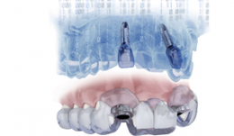 SIMPLANT® Guided Surgery —delivering restorative driven implant treatment