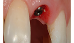 Immediate implant placement -factors influencing the esthetic success