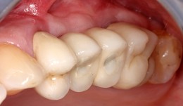 Conventional sinus floor elevation with a new biphasic bone graft material and a slow-resorbing collagen membrane