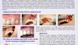 PREDICTIVE VALUE OF CYTOKINES (IL-1β, IL-6, TNF-α), MMP-9 AND uPA  and uPAR GENE POLYMORPHISMS FOR CLINICAL OUTCOMES OF GINGIVAL RECESSION