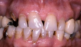 Periodontitis case, fixed reconstructions on teeth and implants