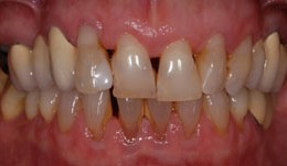 Esthetic improvement in patient with periodontitis