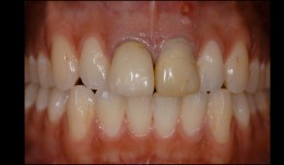 Replacement of two incisors in a young male