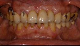Replacement of a functional displeasing prosthesis in the maxilla