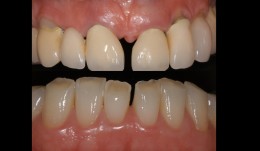 Replacement of maxillary restorations and esthetic rehabilitation