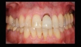 Reinstatement of complete oral health in patient with periodontitis