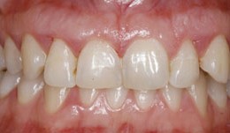 Immediate implant placement after thorough periodontal treatment