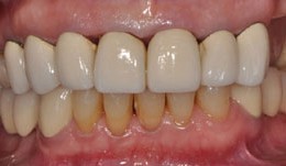 Minimal occlusion with implant-supported cantilever crowns