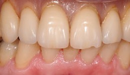 Implants allow palatal-free denture in upper jaw
