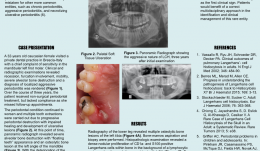 THE ROLE OF MULTIDISCIPLINARY APPROACH IN A CASE OF LANGERHANS CELL HISTIOCYTOSIS WITH INITIAL PERIODONTAL MANIFESTATIONS