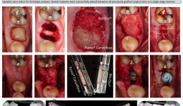 CLINICAL AND HISTOLOGICAL ANALYSIS OF DUAL SOCKET GRAFTING – A PILOT STUDY