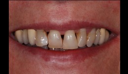 An esthetic rehabilitation of periodontally damaged teeth