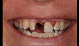 Anterior esthetic case