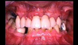 Bilateral reconstruction in a case with gingivitis, FDP on implants
