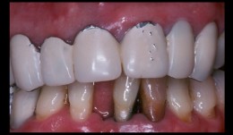 Comprehensive treatment of periodontitis with full mouth reconstruction