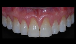 Connective tissue graft with tunnel technique for root coverage