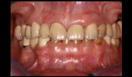 Esthetic and functional restoration