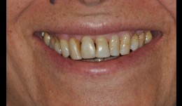 Esthetic improvement in case with generalized gingival recessions