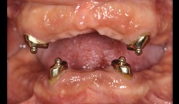 Esthetic improvement in implant-supported fixed and removable dentures