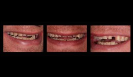 Esthetic rehabilitation in patient with myoarthropathy