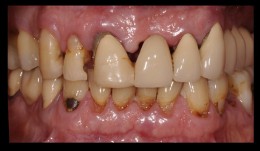 Extensive replacement of old and insufficient restorations