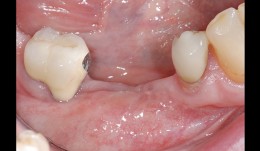Free gingival graft and abutment connection surgery