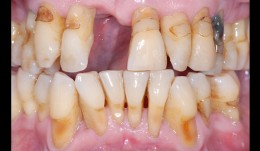 Missing central incisor in addition to severe chronic periodontitis