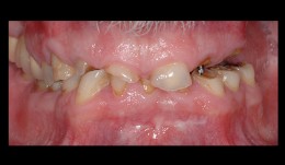 Missing teeth and loss of vertical dimension