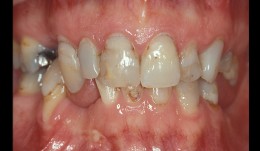 Multiple missing teeth and caries