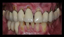 Old ceramic reconstructions in periodontally compromised patient