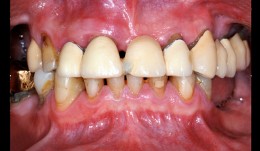 Old reconstructions and missing teeth - a comprehensive case