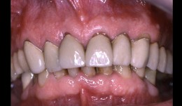 Patient referred has reconstruction in maxilla, shortened dental arch reconstructed