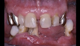 Periodontitis case, fixed reconstructions on implants (bridge and single crown)