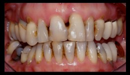 Periodontitis case, smoker, shortened dental arch, reconstructions on implants